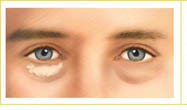 lower eyelid surgery abroad